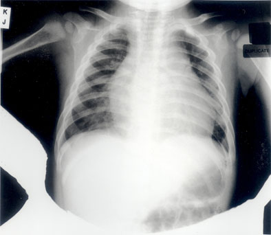 Figure 1. Chest X-ray showing gross cardiomegaly and a small left pleural effusion